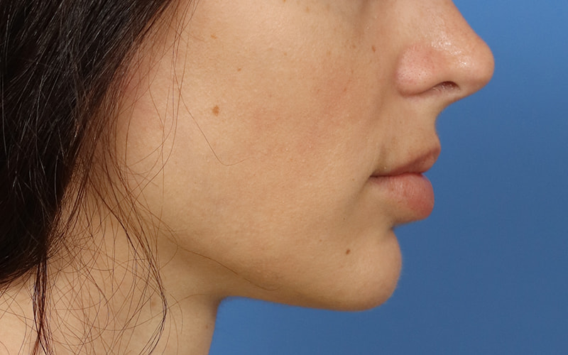 Lip Lift Before & After Image