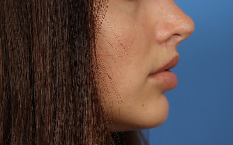 Lip Lift Before & After Image