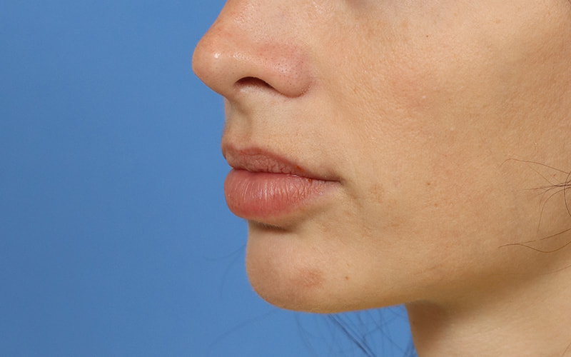Lip Lift Before & After Image