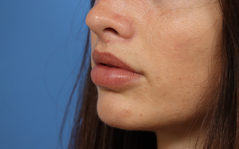 Lip Lift Before & After Image