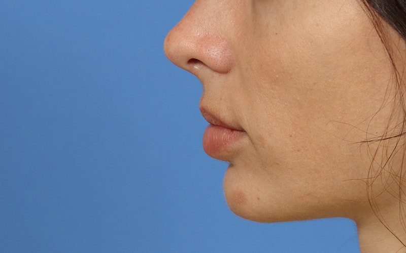 Lip Lift Before & After Image