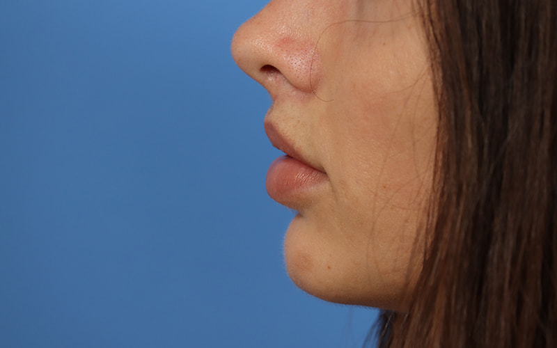 Lip Lift Before & After Image