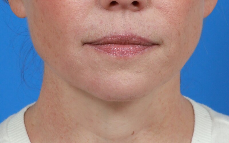 Lip Lift Before & After Image