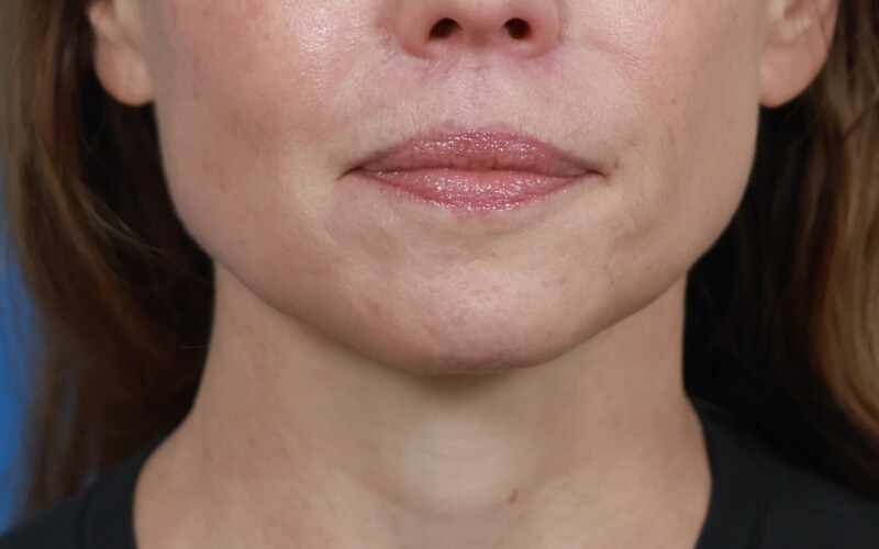 Lip Lift Before & After Image