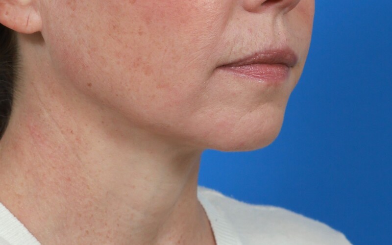 Lip Lift Before & After Image