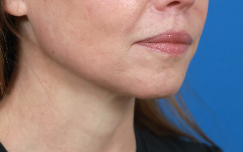 Lip Lift Before & After Image