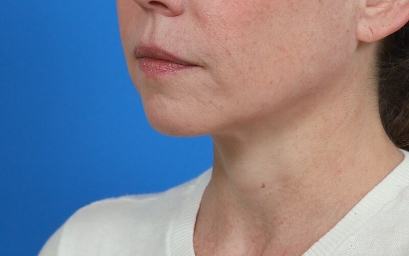 Lip Lift Before & After Image