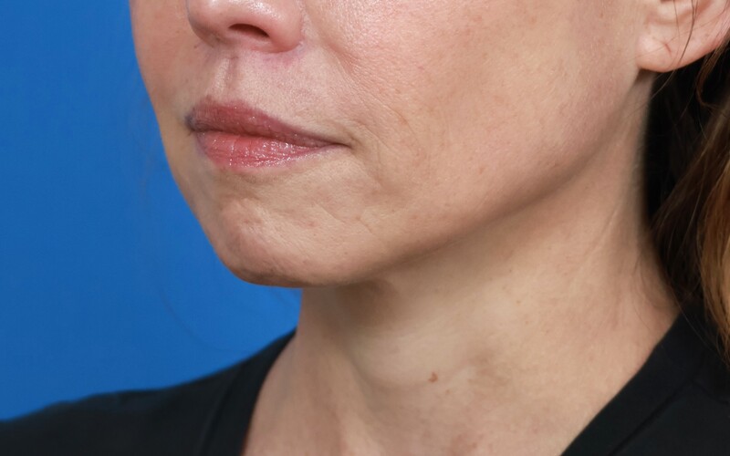 Lip Lift Before & After Image