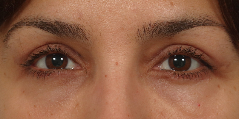 Lower Blepharoplasty Before & After Image