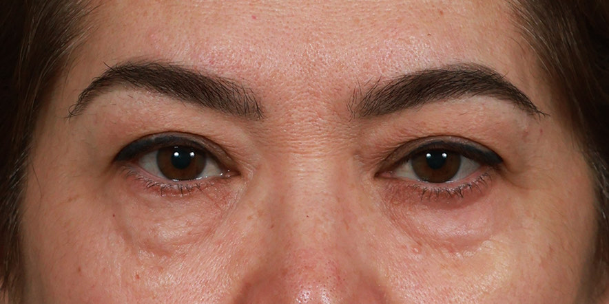 Lower Blepharoplasty Before & After Image