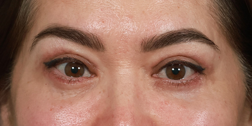 Lower Blepharoplasty Before & After Image