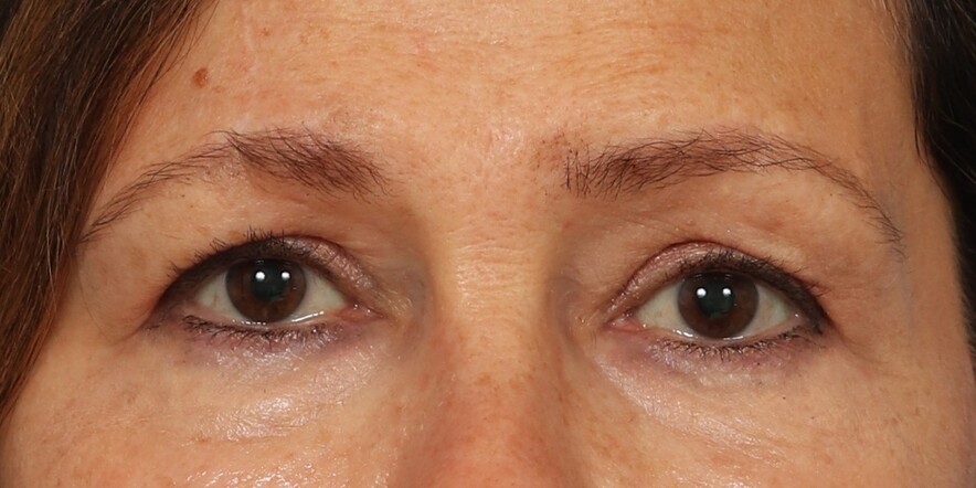Lower Blepharoplasty Before & After Image