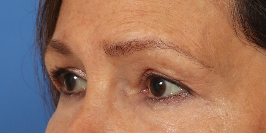 Lower Blepharoplasty Before & After Image