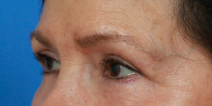 Lower Blepharoplasty Before & After Image