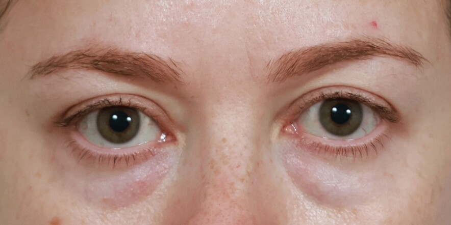Lower Blepharoplasty Before & After Image