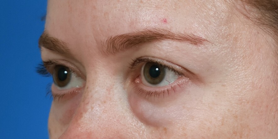 Lower Blepharoplasty Before & After Image