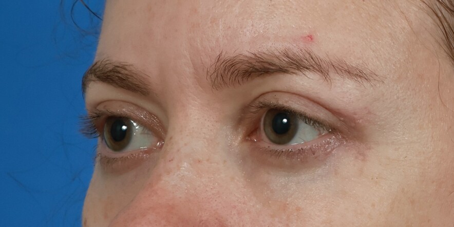 Lower Blepharoplasty Before & After Image