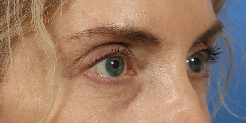Lower Blepharoplasty Before & After Image