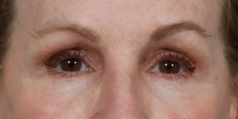 Lower Blepharoplasty Before & After Image