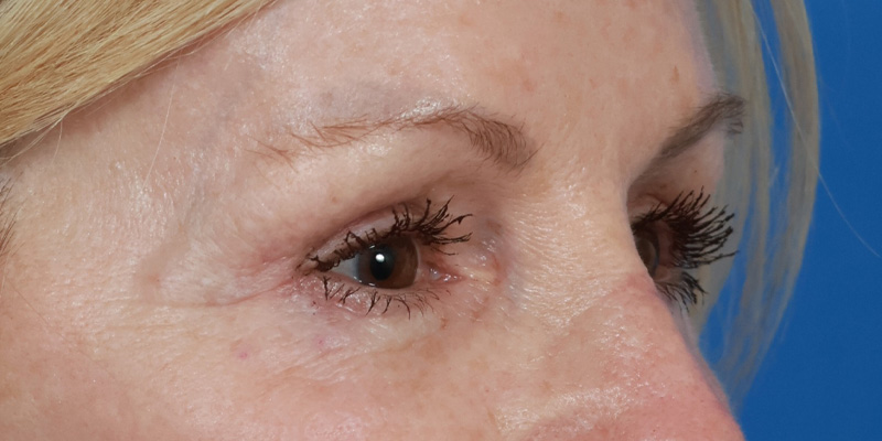 Lower Blepharoplasty Before & After Image