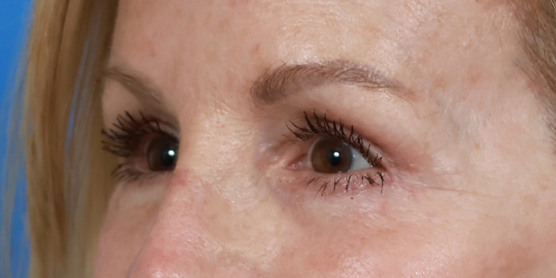 Lower Blepharoplasty Before & After Image