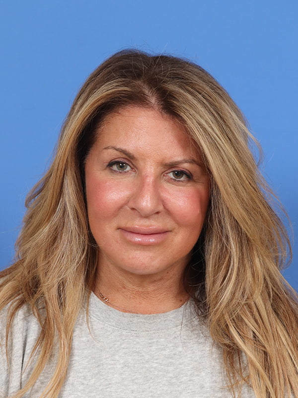 Neck Lift Before & After Image