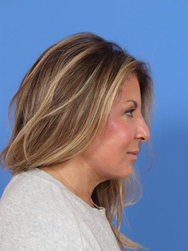 Neck Lift Before & After Image