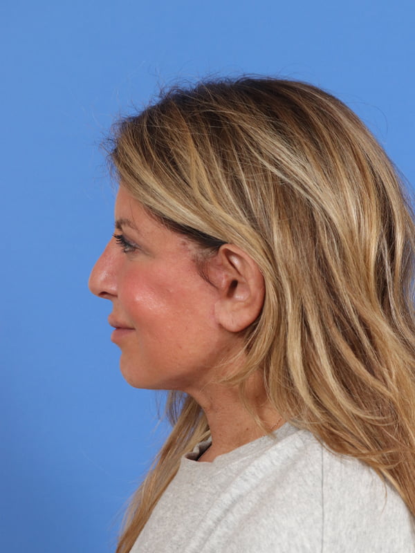 Neck Lift Before & After Image