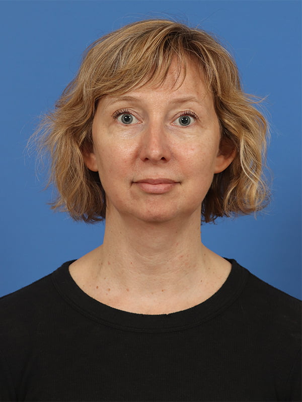 Neck Lift Before & After Image