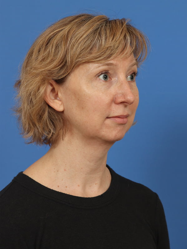 Neck Lift Before & After Image