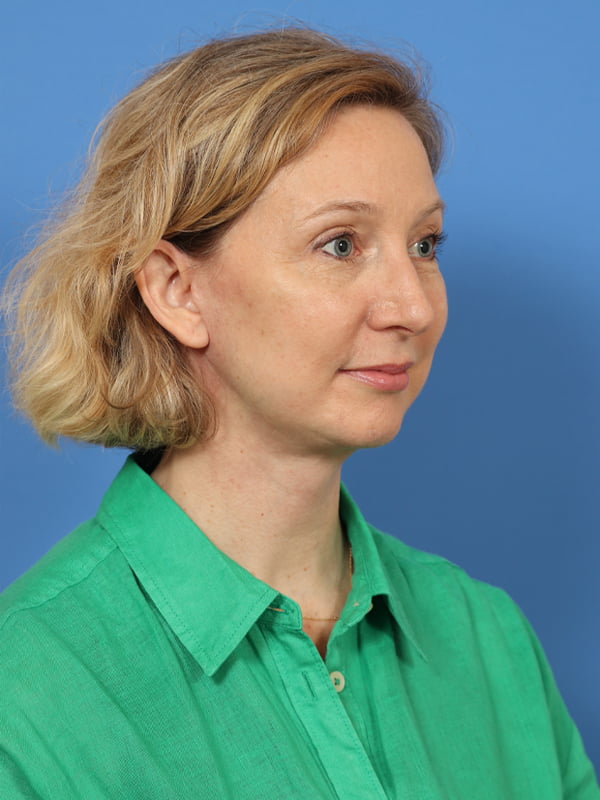 Neck Lift Before & After Image