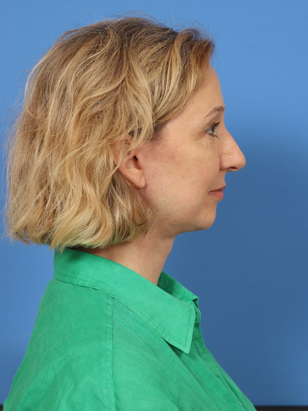 Neck Lift Before & After Image