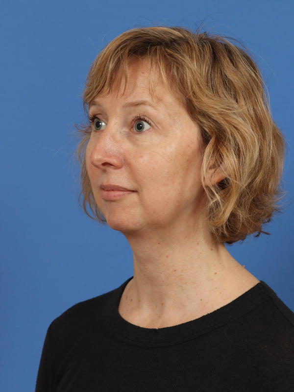 Neck Lift Before & After Image