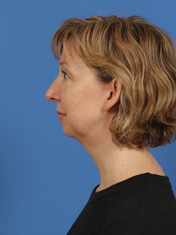 Neck Lift Before & After Image