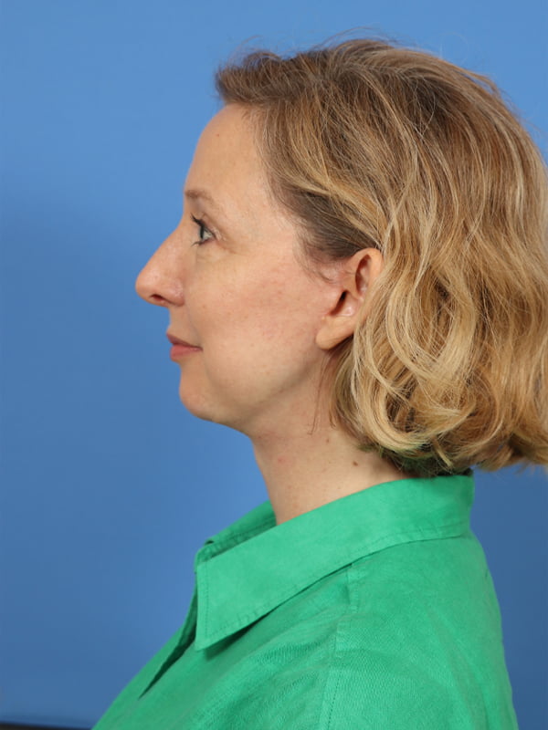 Neck Lift Before & After Image