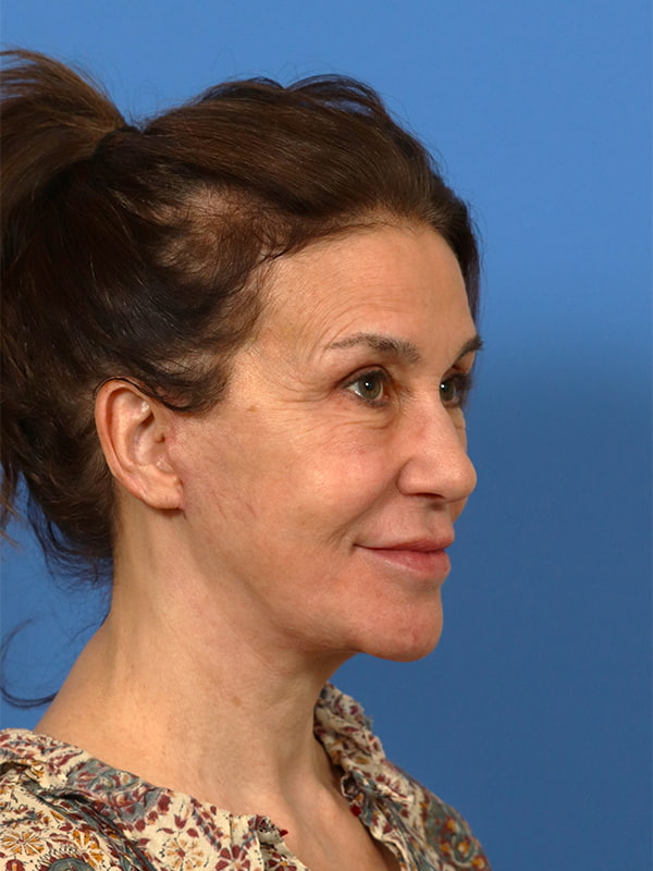 Neck Lift Before & After Image