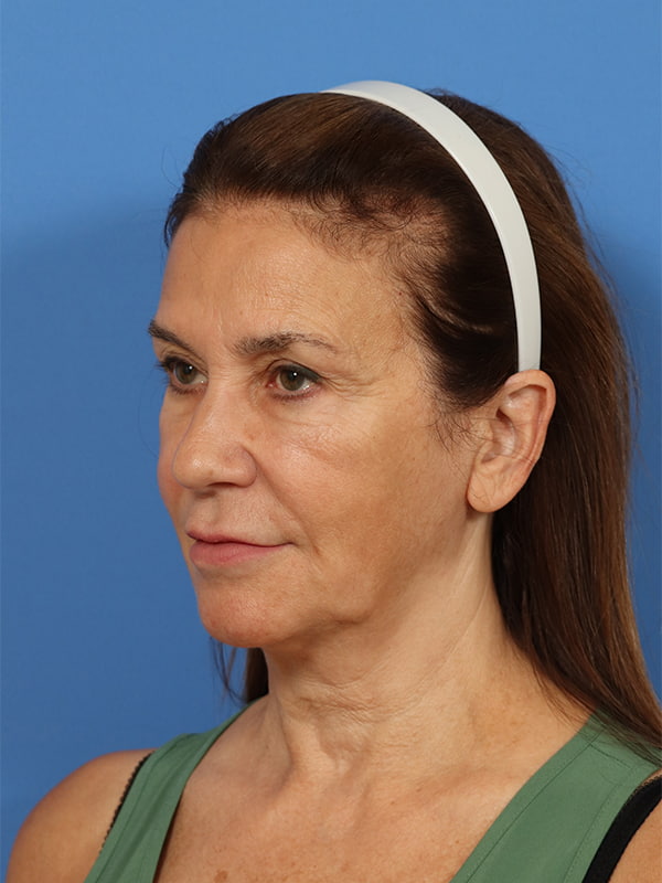 Neck Lift Before & After Image
