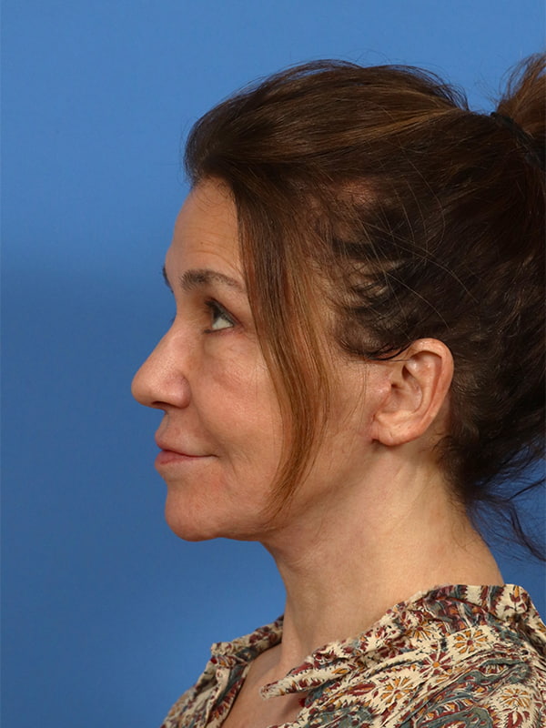 Neck Lift Before & After Image