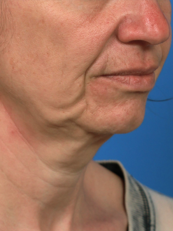 Neck Lift Before & After Image
