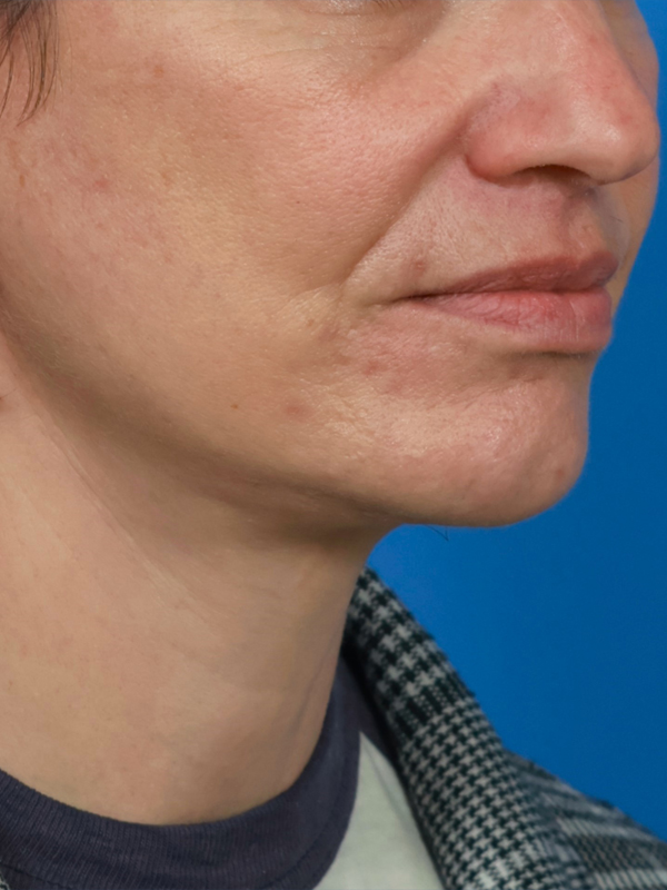 Neck Lift Before & After Image