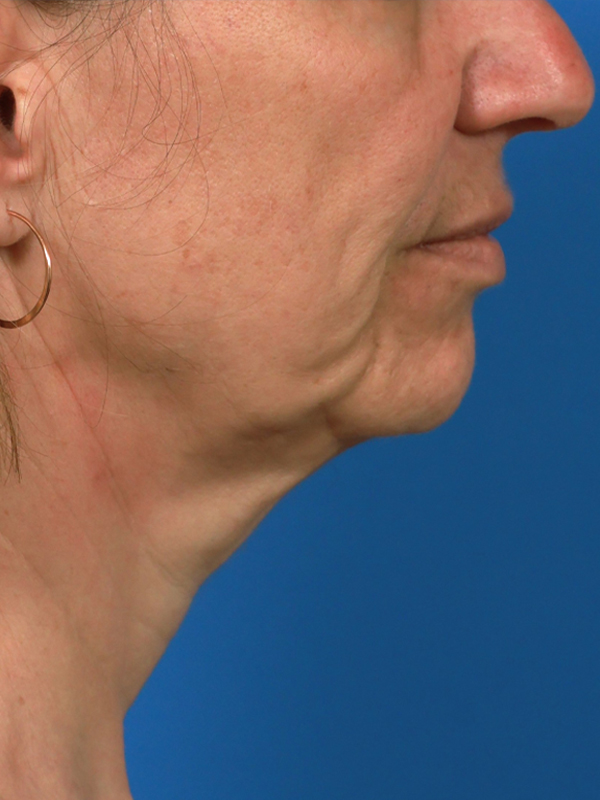 Neck Lift Before & After Image
