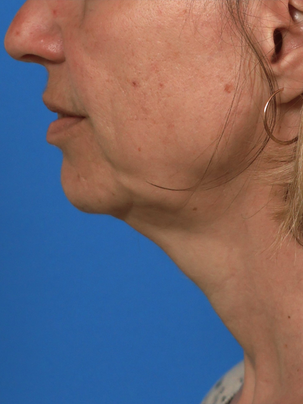 Neck Lift Before & After Image