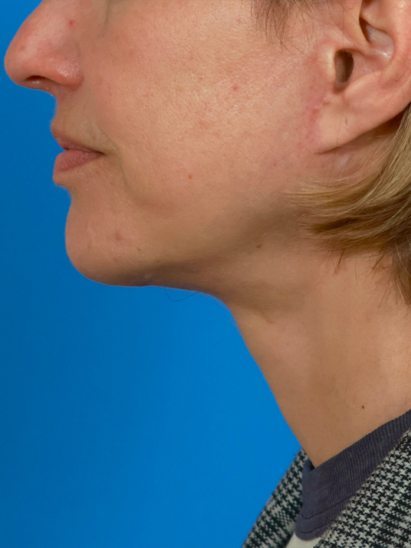 Neck Lift Before & After Image