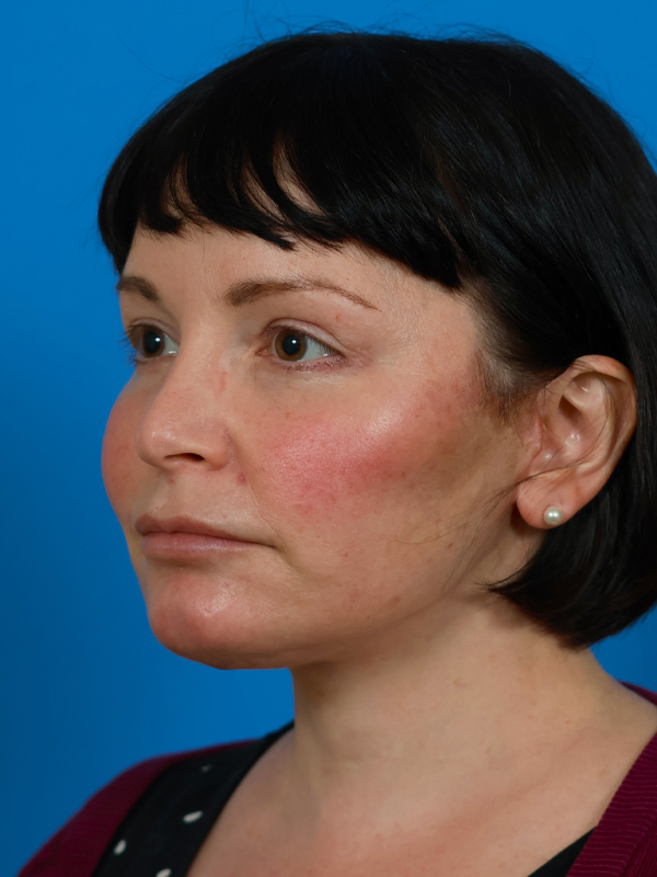 Neck Lift Before & After Image