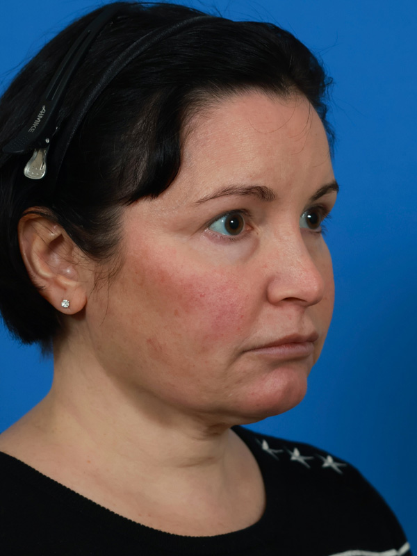 Neck Lift Before & After Image