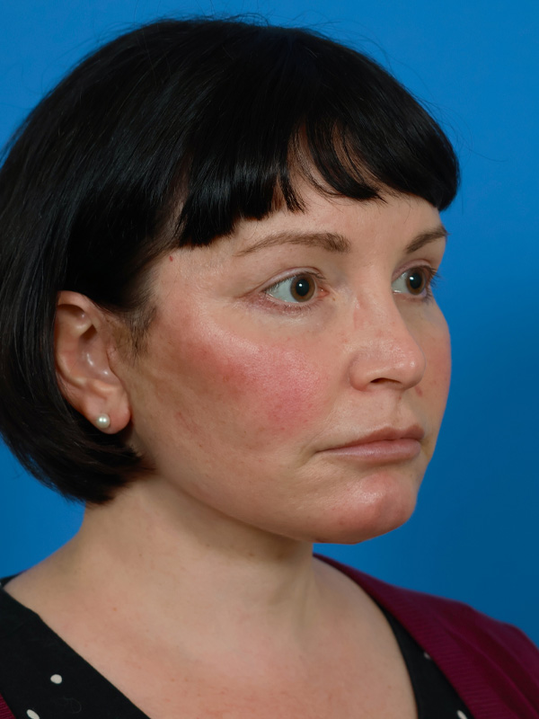 Neck Lift Before & After Image