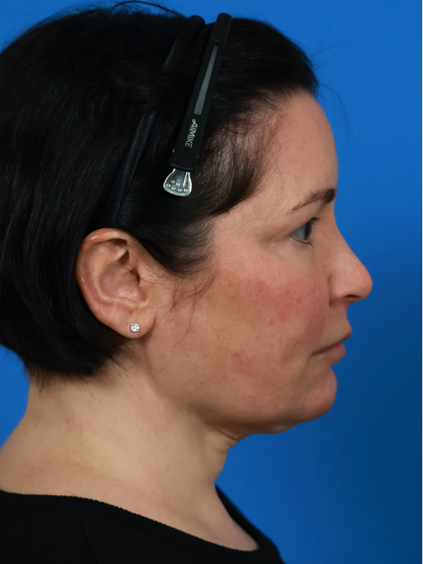 Neck Lift Before & After Image