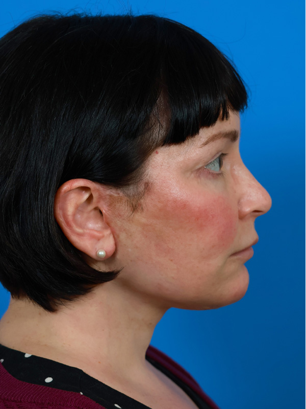 Neck Lift Before & After Image
