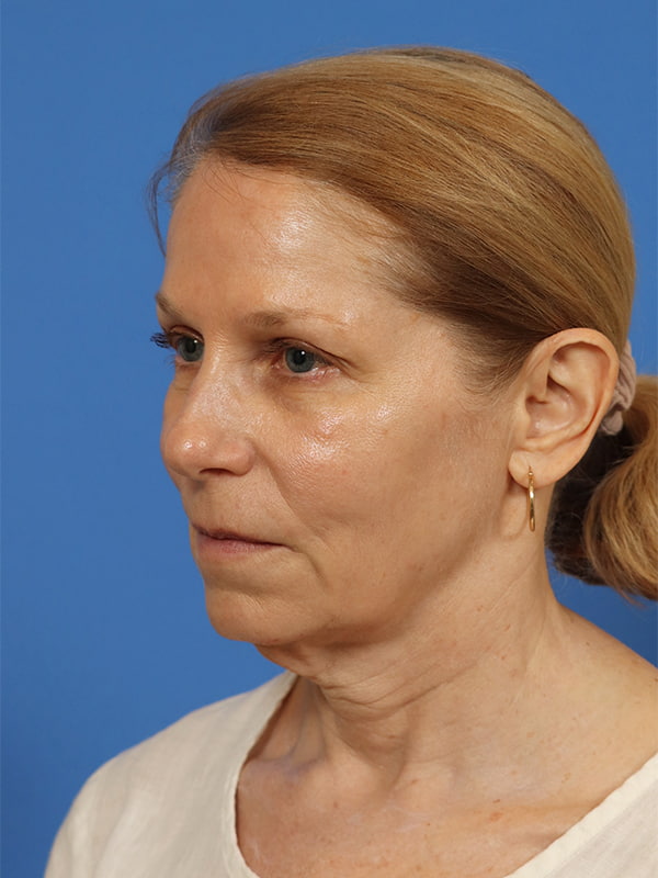 Neck Lift Before & After Image