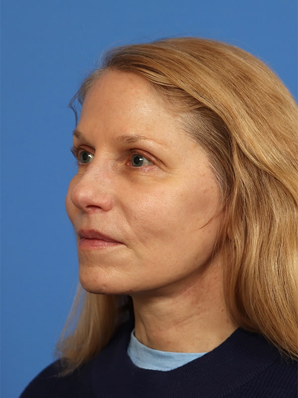 Neck Lift Before & After Image